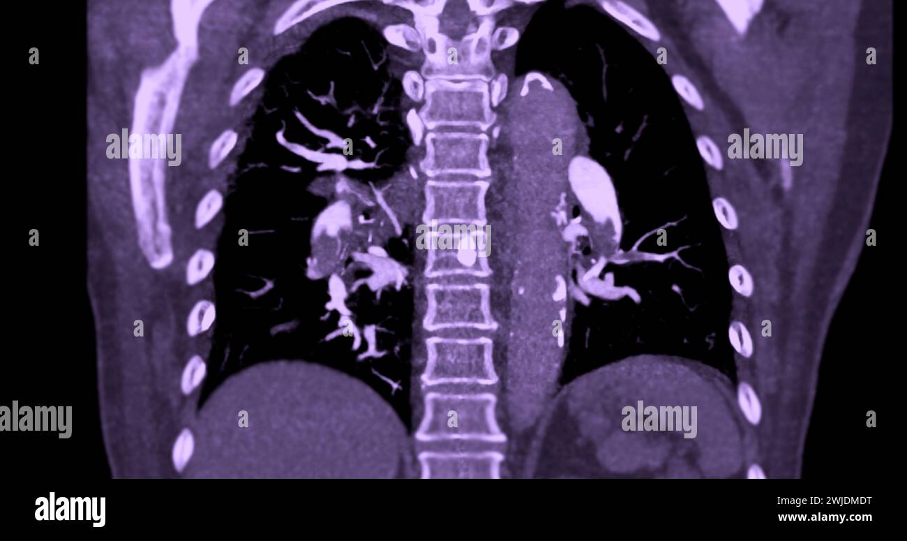 Un'arteria polmonare CTA rivela una vista dettagliata dei vasi sanguigni polmonari, catturando la presenza di embolia polmonare, una condizione in cui una cl ematica Foto Stock