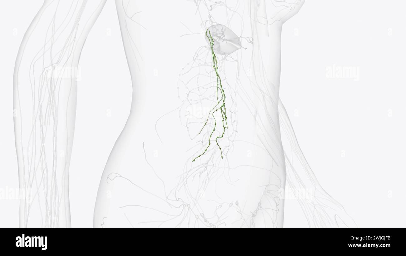 La linfa aortica risultante dalla legatura linfatica favorisce lo sviluppo della lesione aterosclerotica illustrazione 3d. Foto Stock