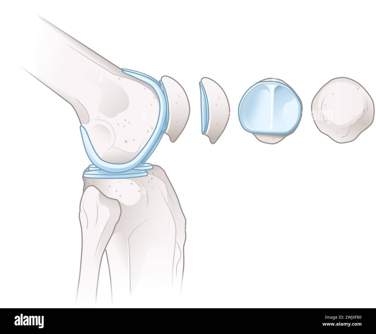 illustrazione che mostra le ossa e la cartilagine di un'articolazione del ginocchio. Foto Stock