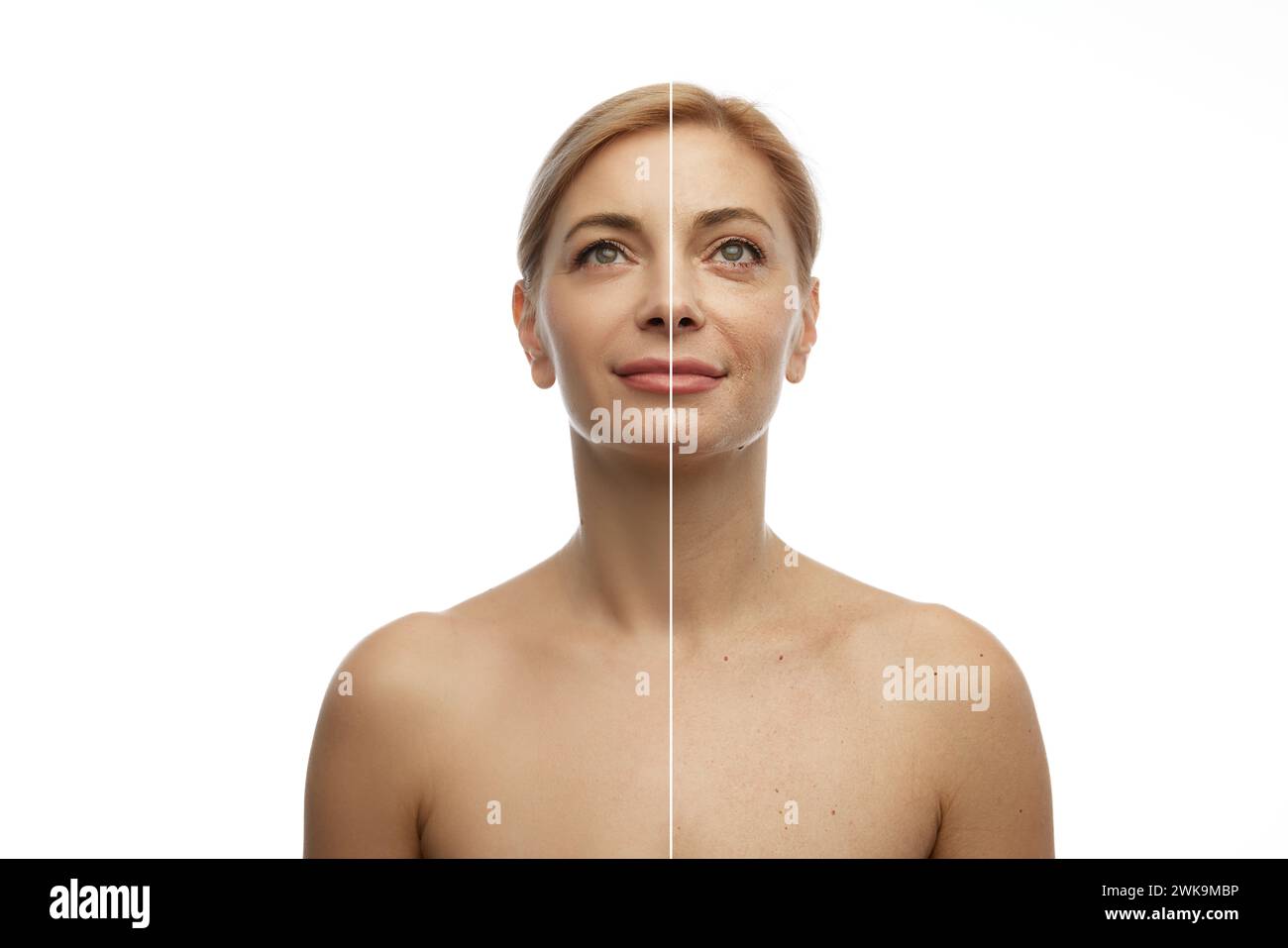 Prima e dopo il trattamento per la cura della pelle. Confronto mezza faccia di una bella giovane donna con un chiaro contrasto della pelle. Procedure spa anti-invecchiamento. Foto Stock