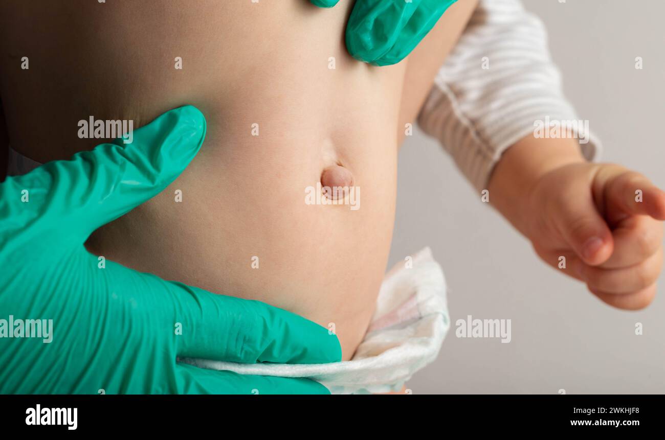 Un medico chirurgo in guanti medici esamina l'addome di un neonato con un anello ombelicale ingrossato e un'ernia ombelicale, primo piano. Foto Stock