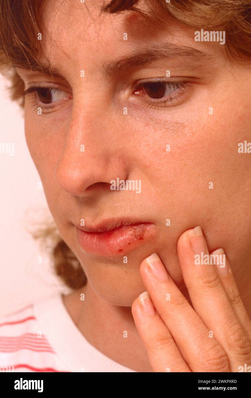 giovane donna che sembra triste con coldsori, piaghe fredde, che eruttano sul labbro inferiore Foto Stock