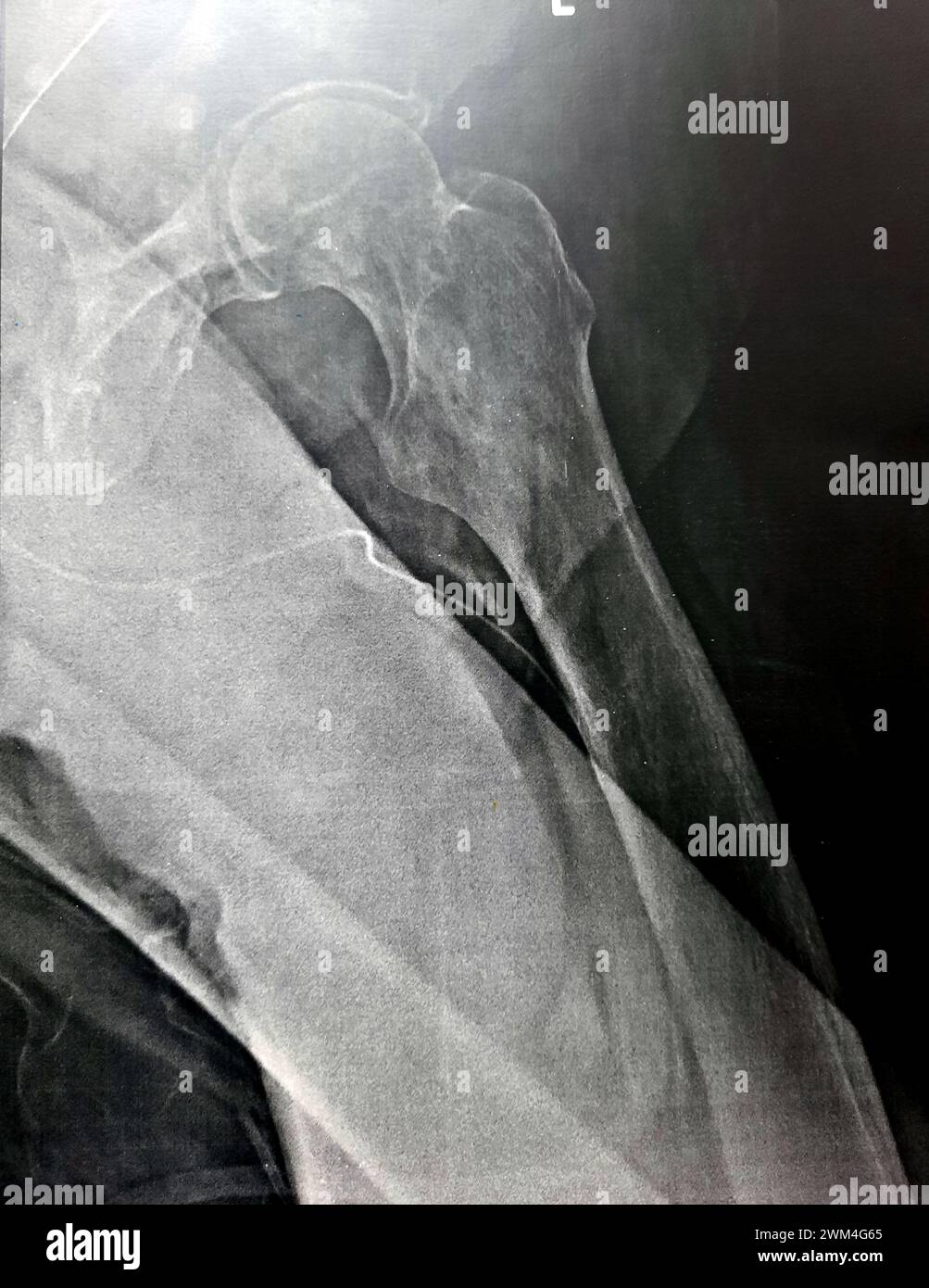 Radiografia semplice con alta probabilità di frattura subtrocanterica, trocanterica e metastasi maligne nel lato mediale dell'albero femorale sottostante Foto Stock