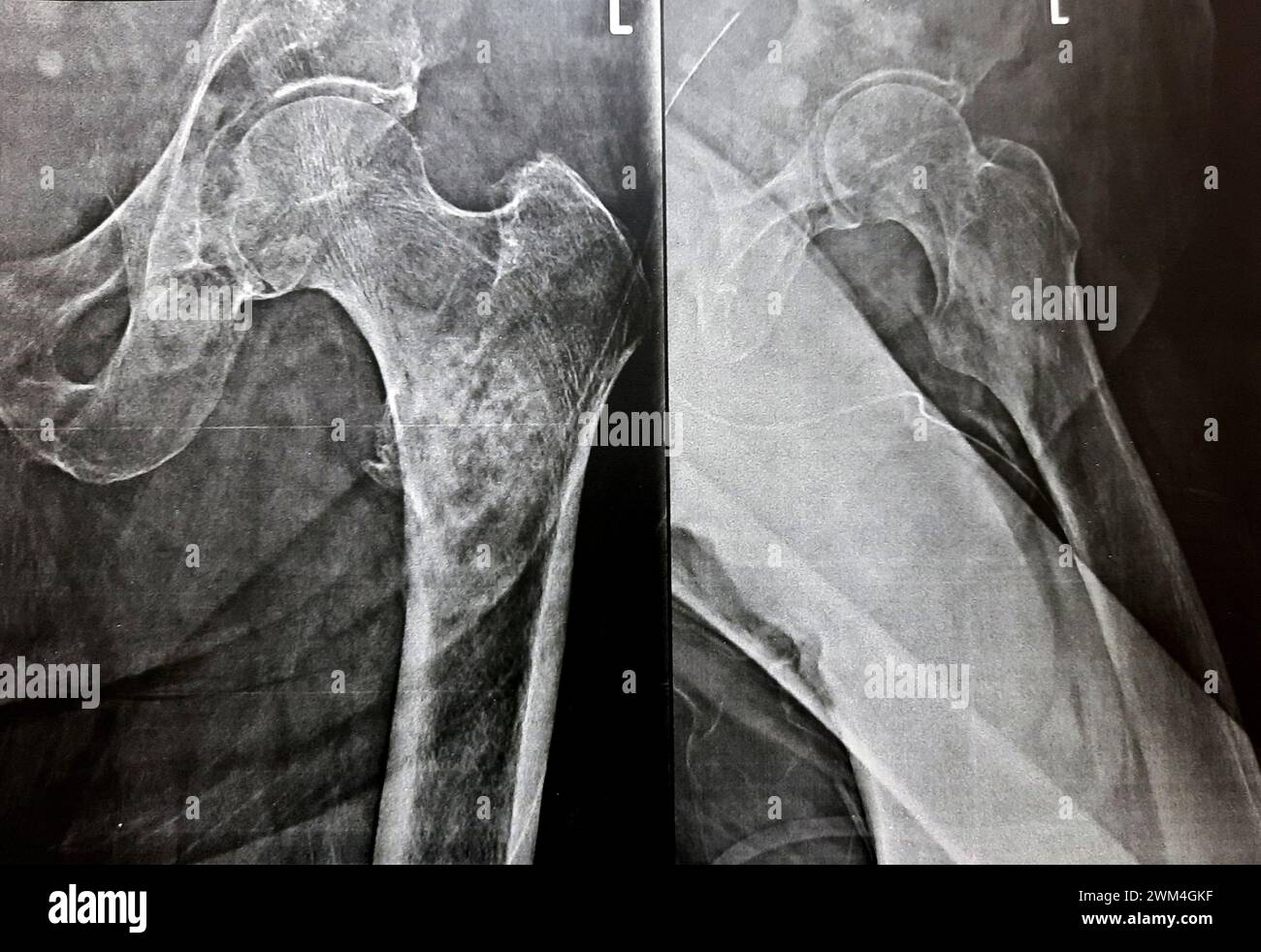 Radiografia semplice con alta probabilità di frattura subtrocanterica, trocanterica e metastasi maligne nel lato mediale dell'albero femorale sottostante Foto Stock