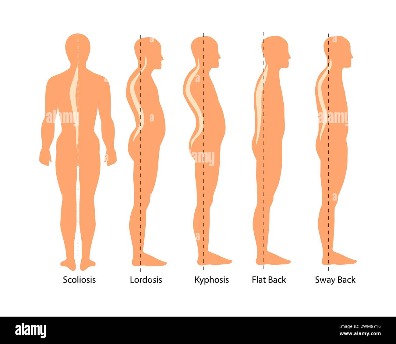 Illustrazione medica dei tipi di deformità spinale: Scoliosi, lordosi e cifosi, oscillazione. Difetto di postura corporea. Infografiche malattie della colonna vertebrale. Illustrazione Vettoriale