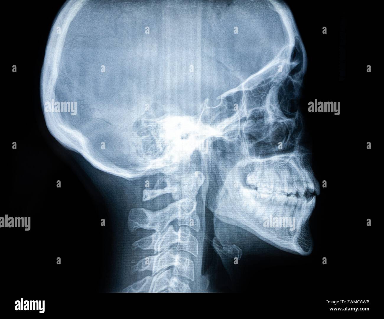 Immagine a raggi X di un cranio femminile e di una mascella con denti Foto Stock