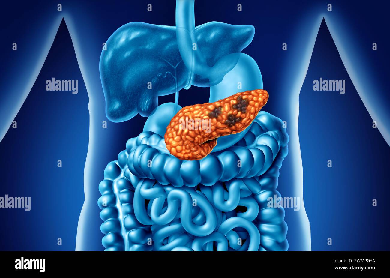 Cancro al pancreas concetto di anatomia e pancreas tumore maligno simbolo come una ghiandola digestiva parte del corpo con un ingrandimento al microscopio di tumori maligni tum Foto Stock