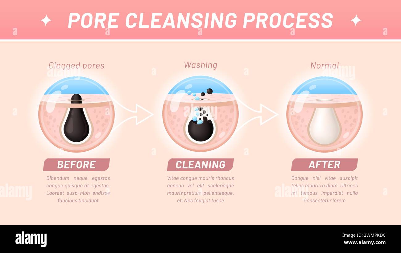 Pulizia della pelle, processo di pulizia dei pori. Le infografiche vettoriali passo-passo prevedono la rimozione di detriti, olio e cellule morte dalla cute ostruita, esfoliazione e lavaggio, prima e dopo l'aiuto visivo Illustrazione Vettoriale