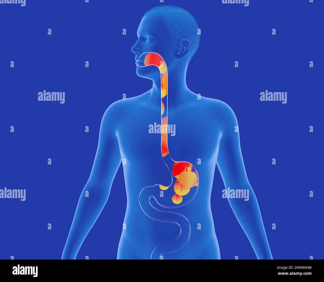 Illustrazione anatomica 3D dello stomaco e dell'esofago con reflusso alla bocca. Con ardore e fuoco. Apparato digerente e figura umana trasparente. Foto Stock