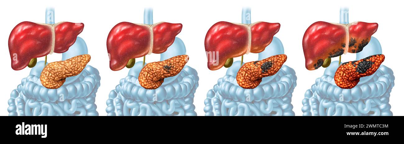 Il concetto di stadi del cancro pancreatico e la malattia del pancreas come stadio di crescita tumorale maligna come una ghiandola digestiva con cellule cancerose che si dividono e si diffondono Foto Stock