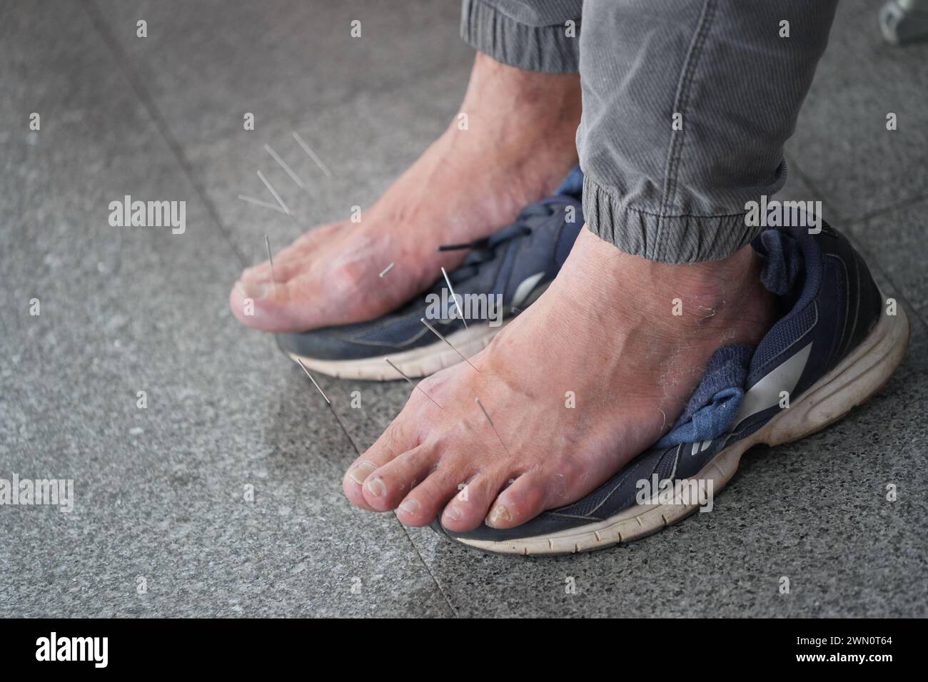 Primo piano di una persona che riceve trattamento di agopuntura in una pratica medica Foto Stock