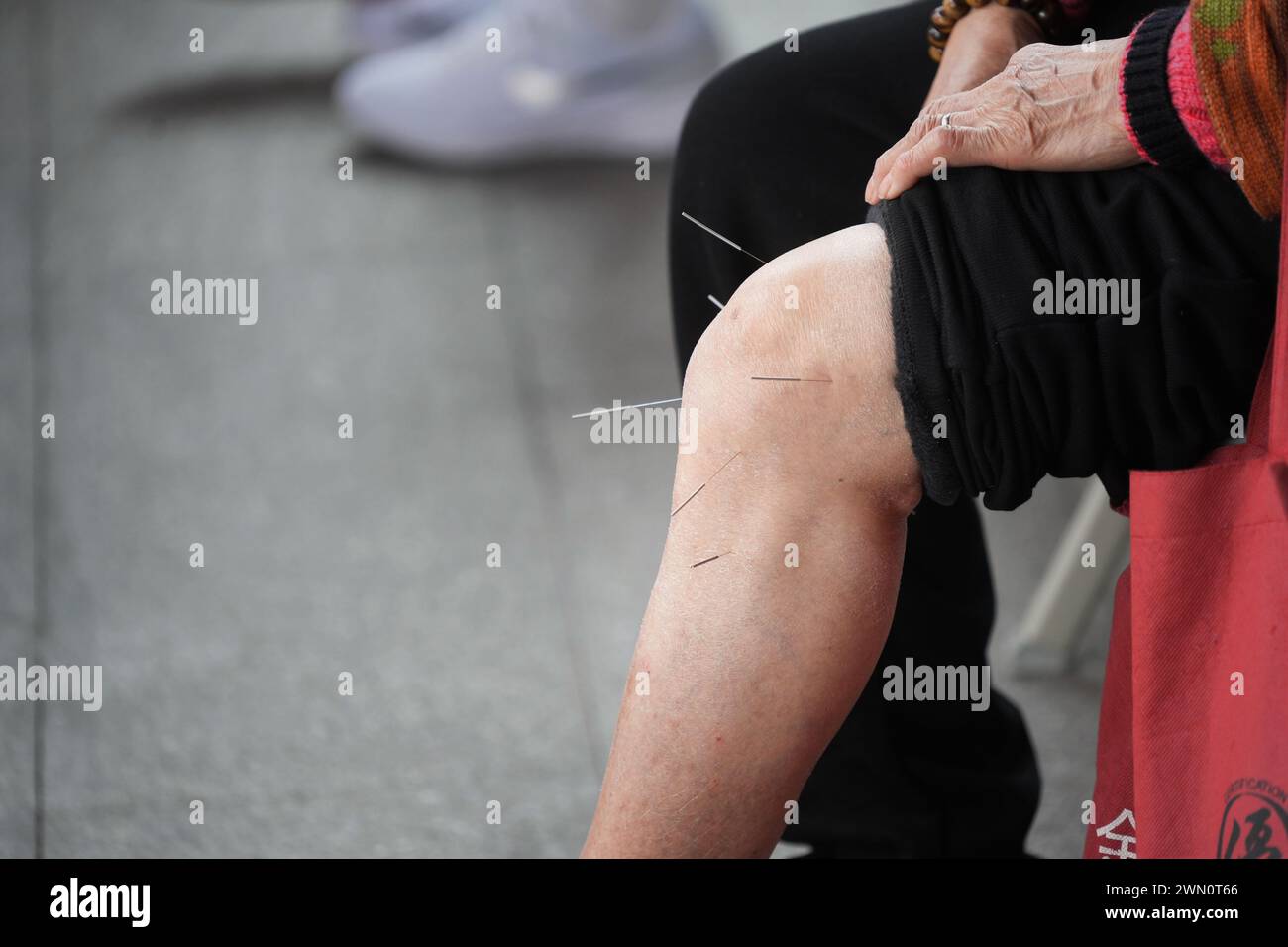 Primo piano di una persona che riceve trattamento di agopuntura in una pratica medica Foto Stock