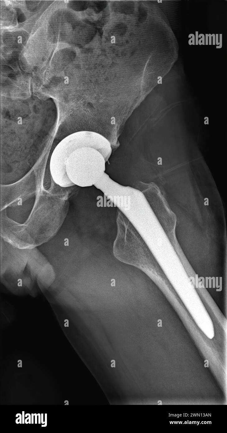 Radiografia della protesi dell'anca sinistra. Vista laterale. 12 settimane dopo la sostituzione totale dell'anca Foto Stock