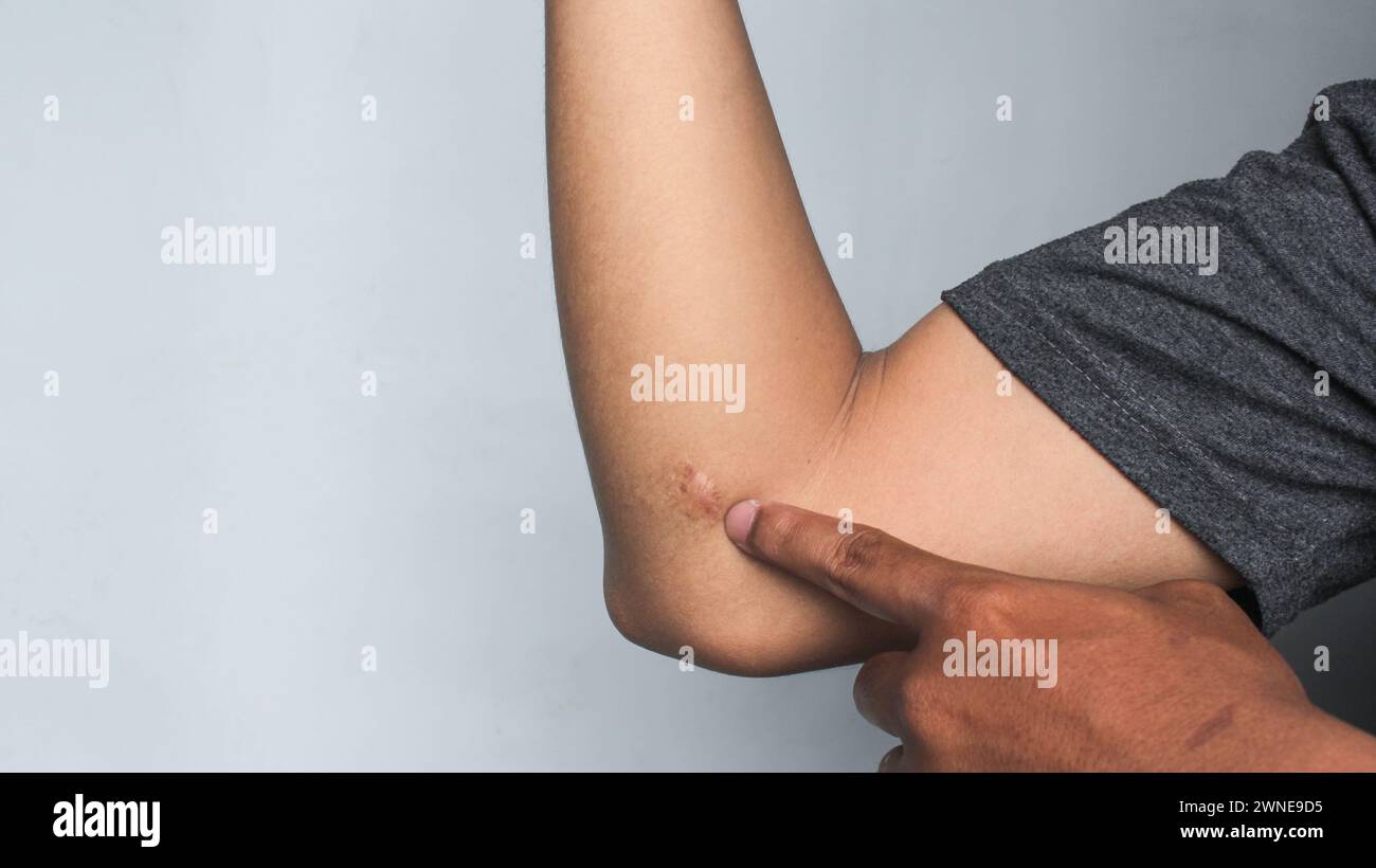 Cicatrice sulla pelle umana keloide sul gomito. Foto Stock