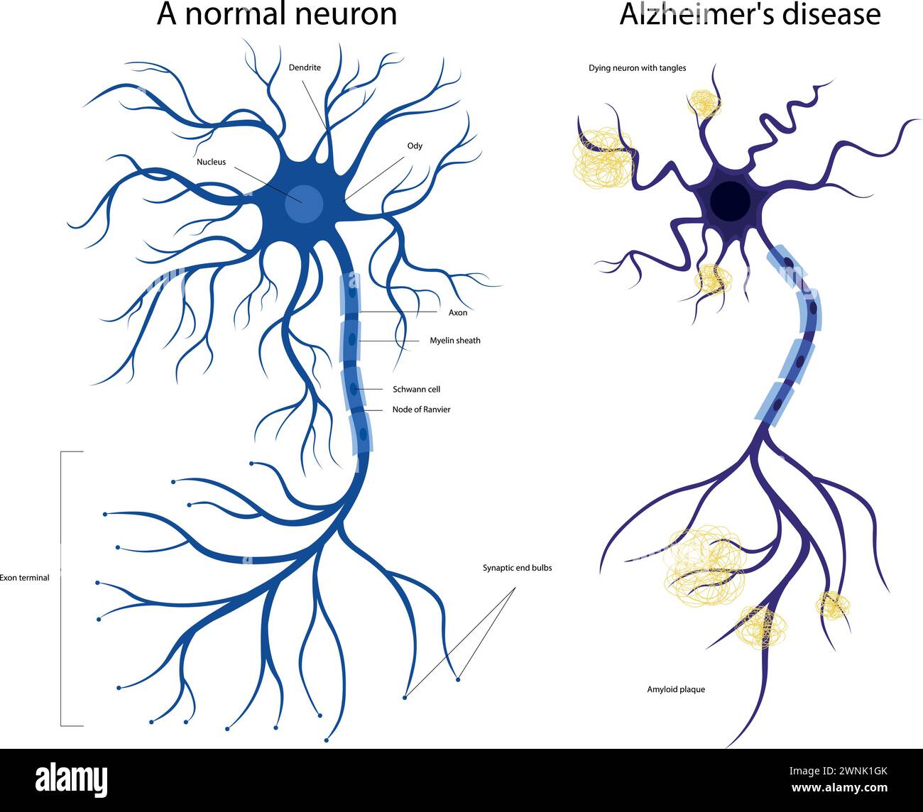 La struttura di un neurone malato e sano. Neurone danneggiato. Malattia di Alzheimer. Malattia cerebrale demenza, disturbi della memoria. Un neurone nell'Alzheimer Illustrazione Vettoriale