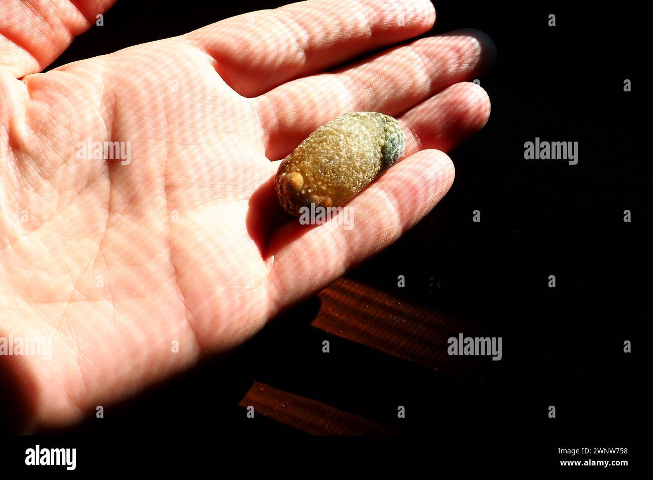 Malattia del calcoli biliari, colelitiasi - la formazione di pietre, calcoli nella cistifellea, dotti biliari. Calcoli biliari. Un grande gallone rimosso da a. Foto Stock