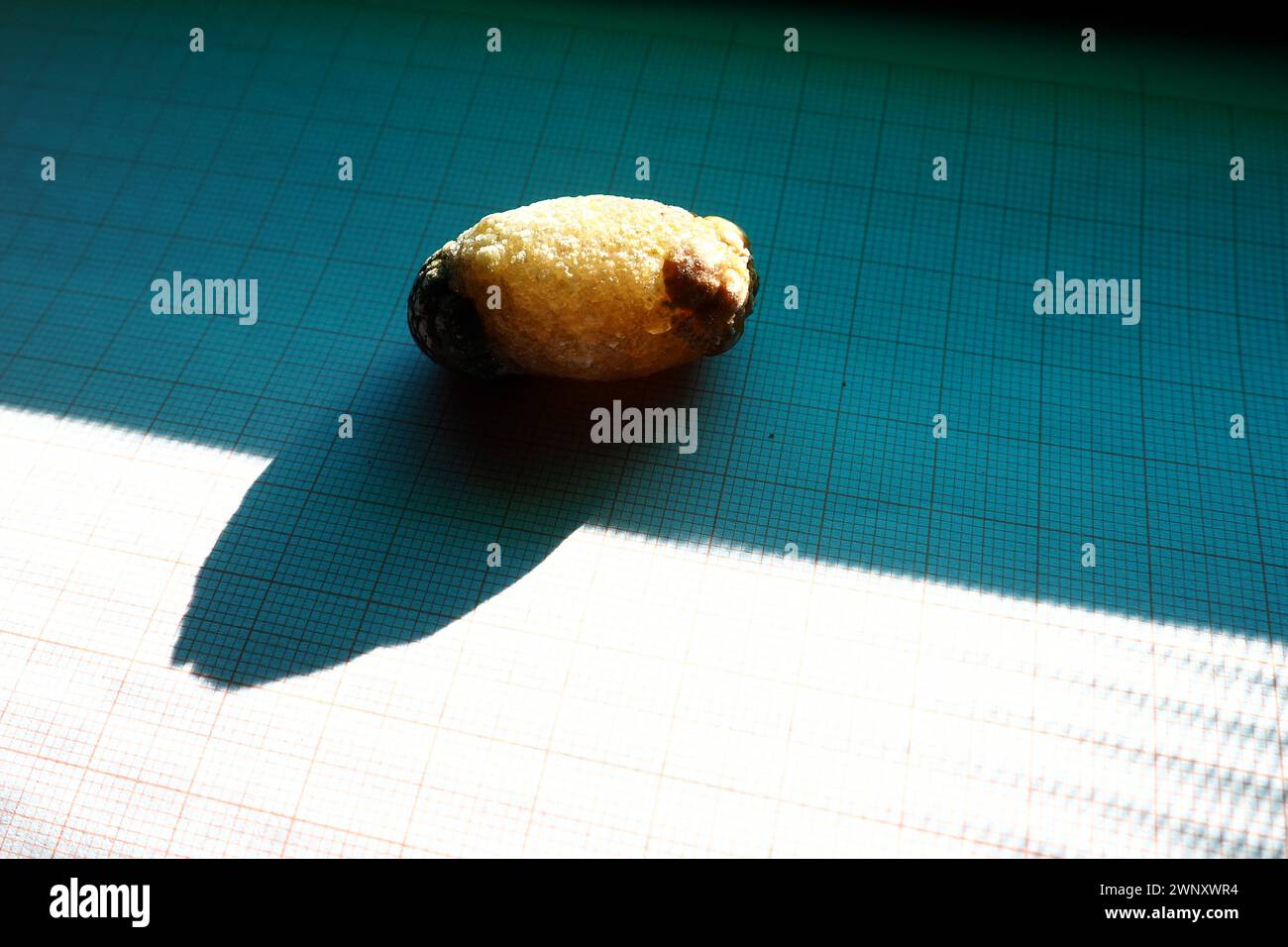 Malattia del calcoli biliari, colelitiasi - la formazione di pietre, calcoli nella cistifellea, dotti biliari. Calcoli biliari. Un grande gallone rimosso da a. Foto Stock