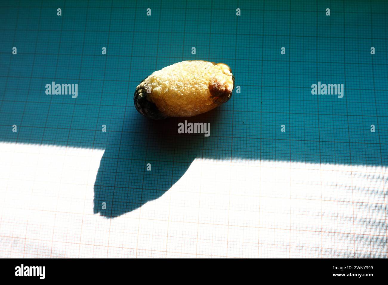 Malattia del calcoli biliari, colelitiasi - la formazione di pietre, calcoli nella cistifellea, dotti biliari. Calcoli biliari. Un grande gallone rimosso da a. Foto Stock