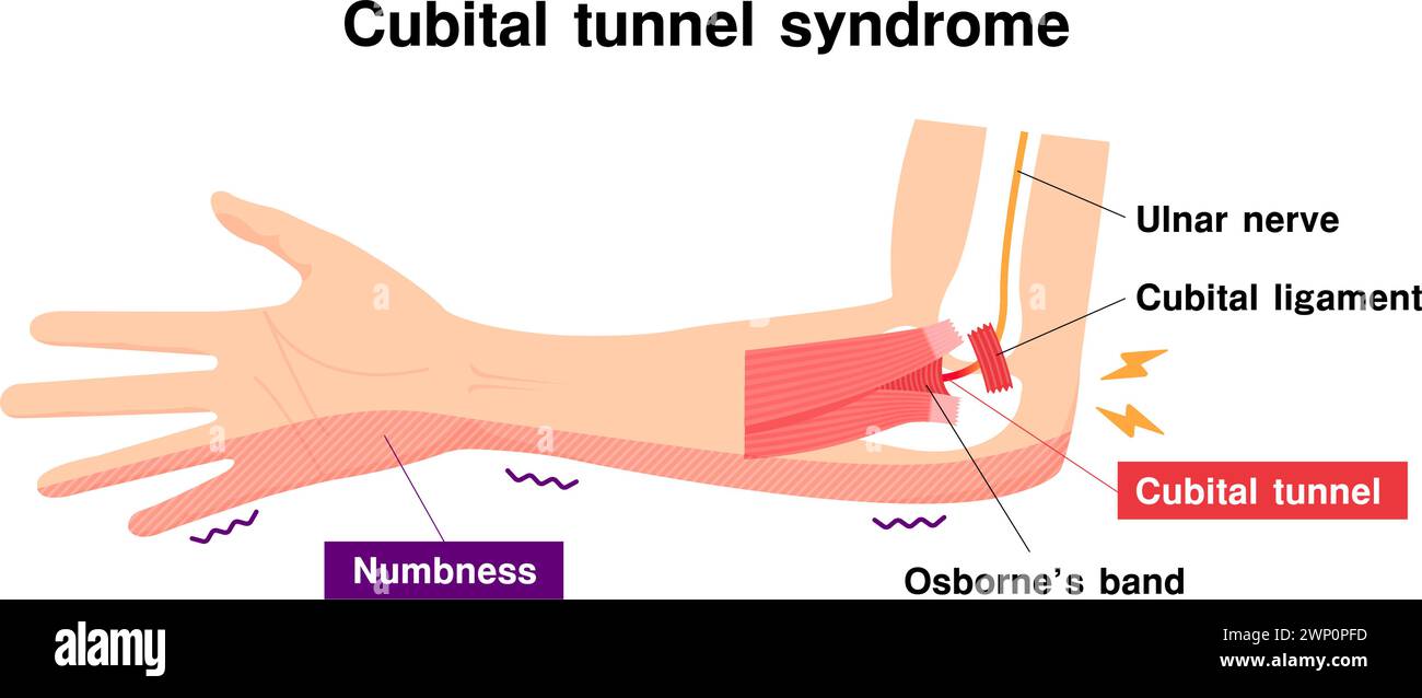 Illustrazione vettoriale della sindrome del tunnel cubitale Illustrazione Vettoriale