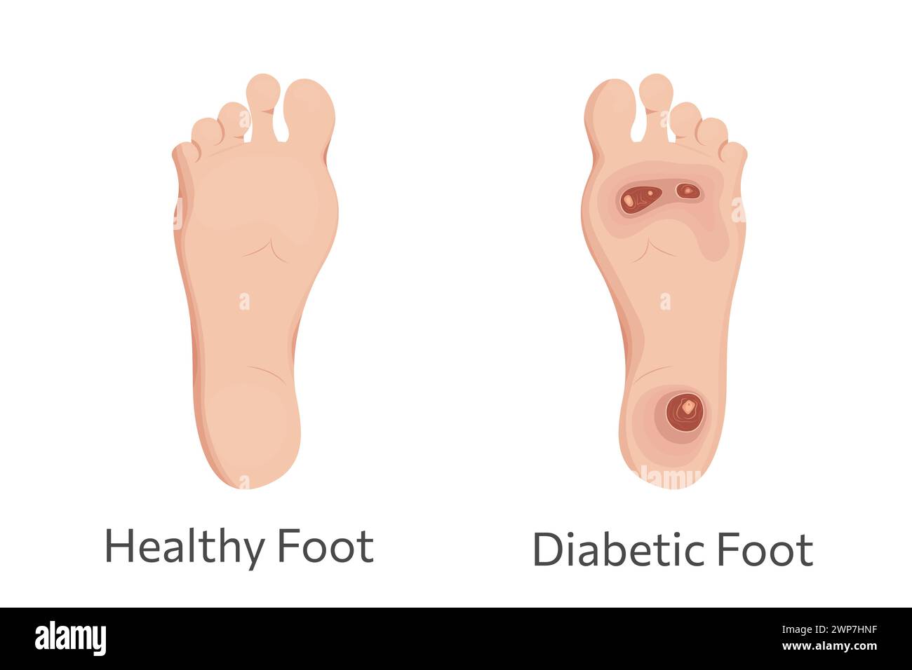 Illustrazione del vettore dei piedi diabetici e sani. Trattamento del diabete e dell'ulcera. Illustrazione Vettoriale