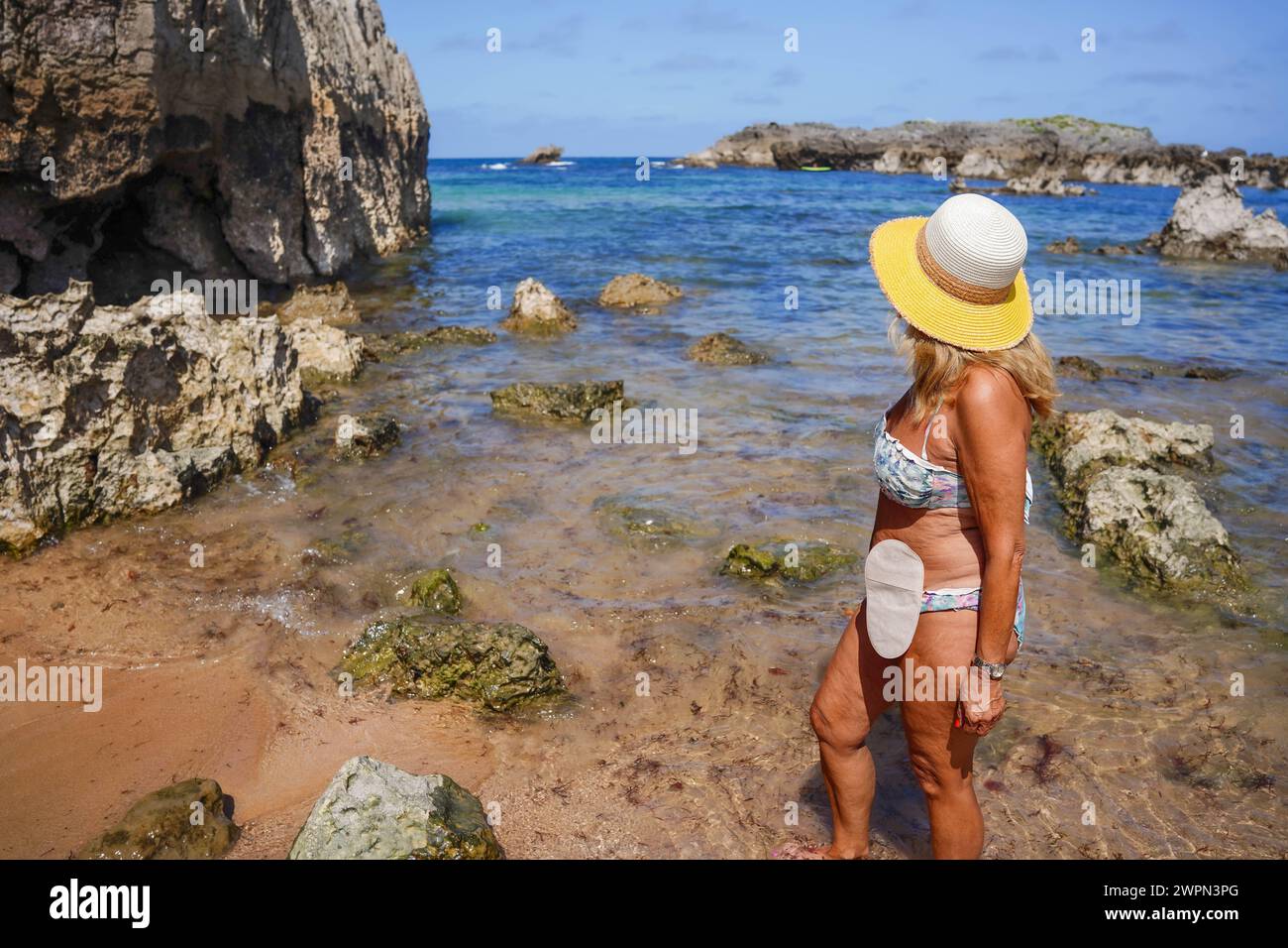 donna sopravvissuta al cancro del colon sulla spiaggia con una borsa per ostomia in estate. Giorno del cancro al colon Foto Stock