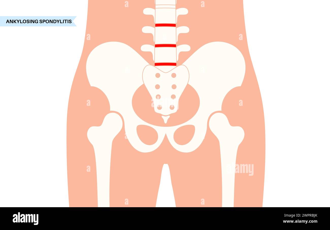 Spondilite anchilosante, illustrazione Foto Stock