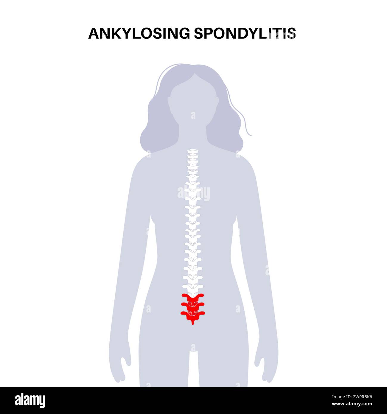 Spondilite anchilosante, illustrazione Foto Stock