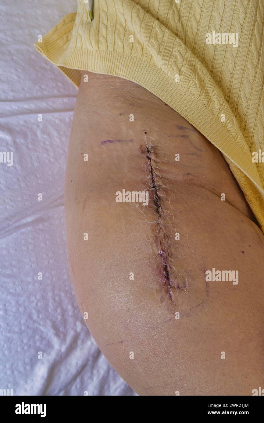 Cicatrice post intervento dopo intervento chirurgico di sostituzione dell'anca (femmina) Foto Stock