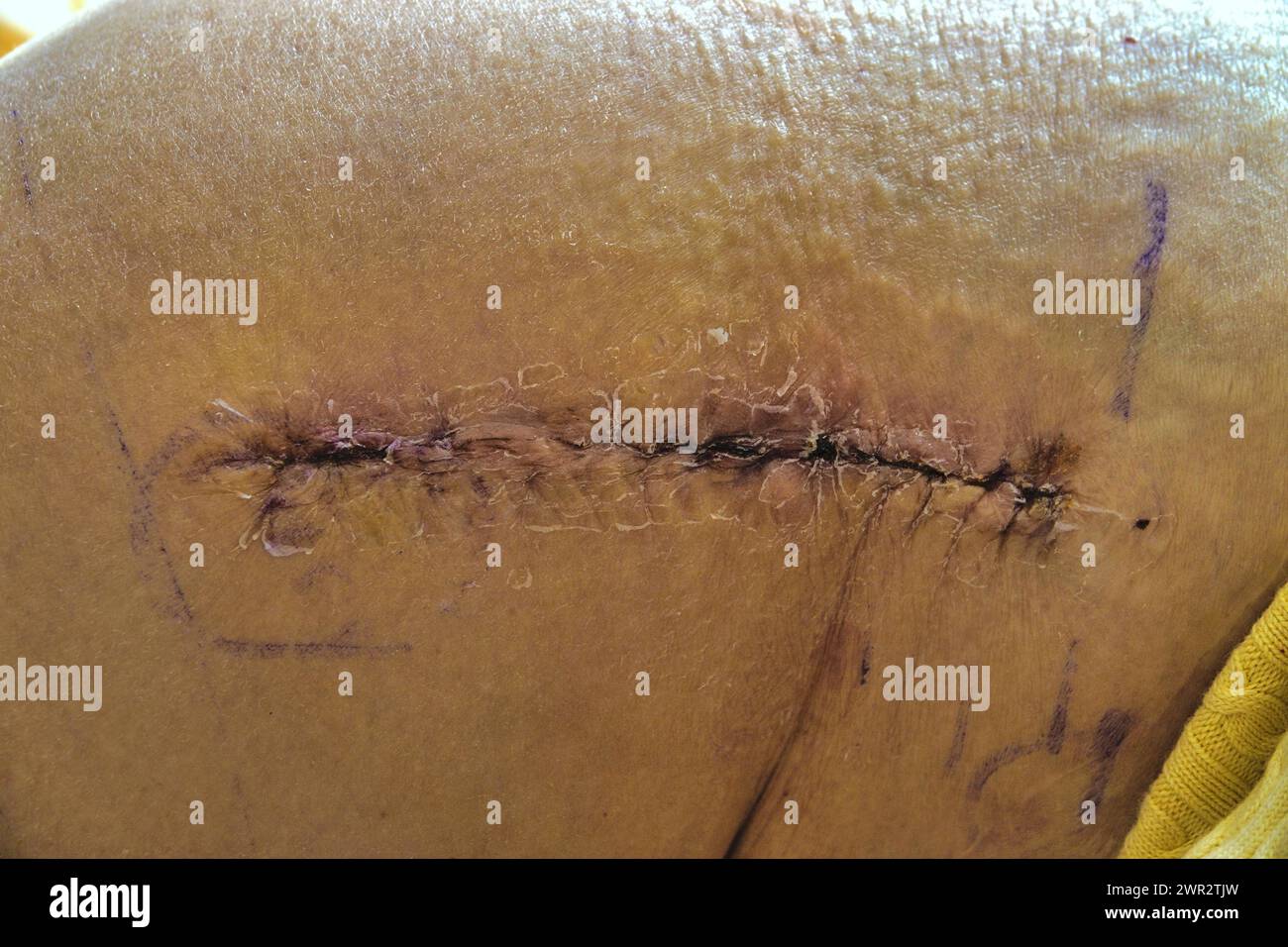 Cicatrice post intervento dopo intervento chirurgico di sostituzione dell'anca (femmina) Foto Stock