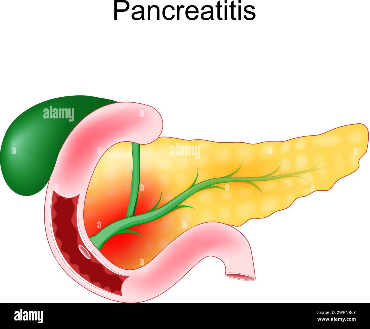 Pancreatite acuta. Infiammazione del pancreas. Illustrazione vettoriale realistica di duodeno, cistifellea e pancreas. Illustrazione Vettoriale