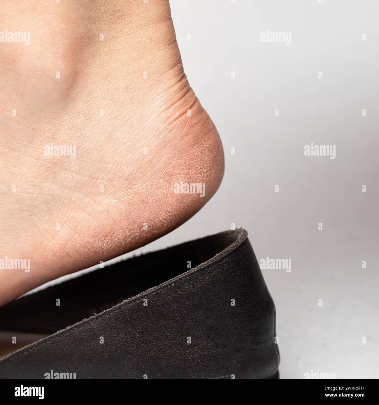 Immagine dettagliata di un piede con pelle asciutta e fessurata sul tallone che entra in una scarpa nera slip-on, evidenziando la necessità di idratazione del piede Foto Stock