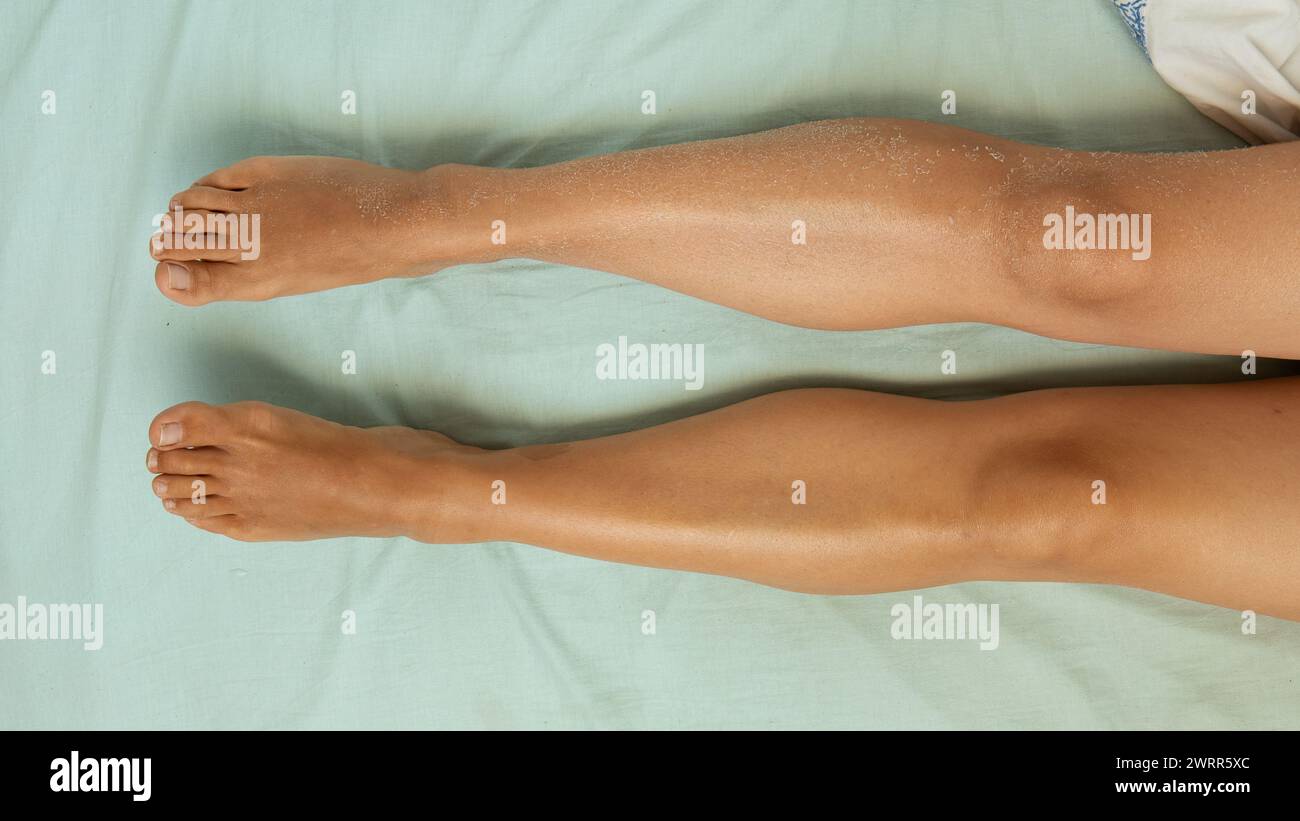 Un confronto unico tra pelle secca e idratata, che dimostra l'importanza dell'idratazione Foto Stock