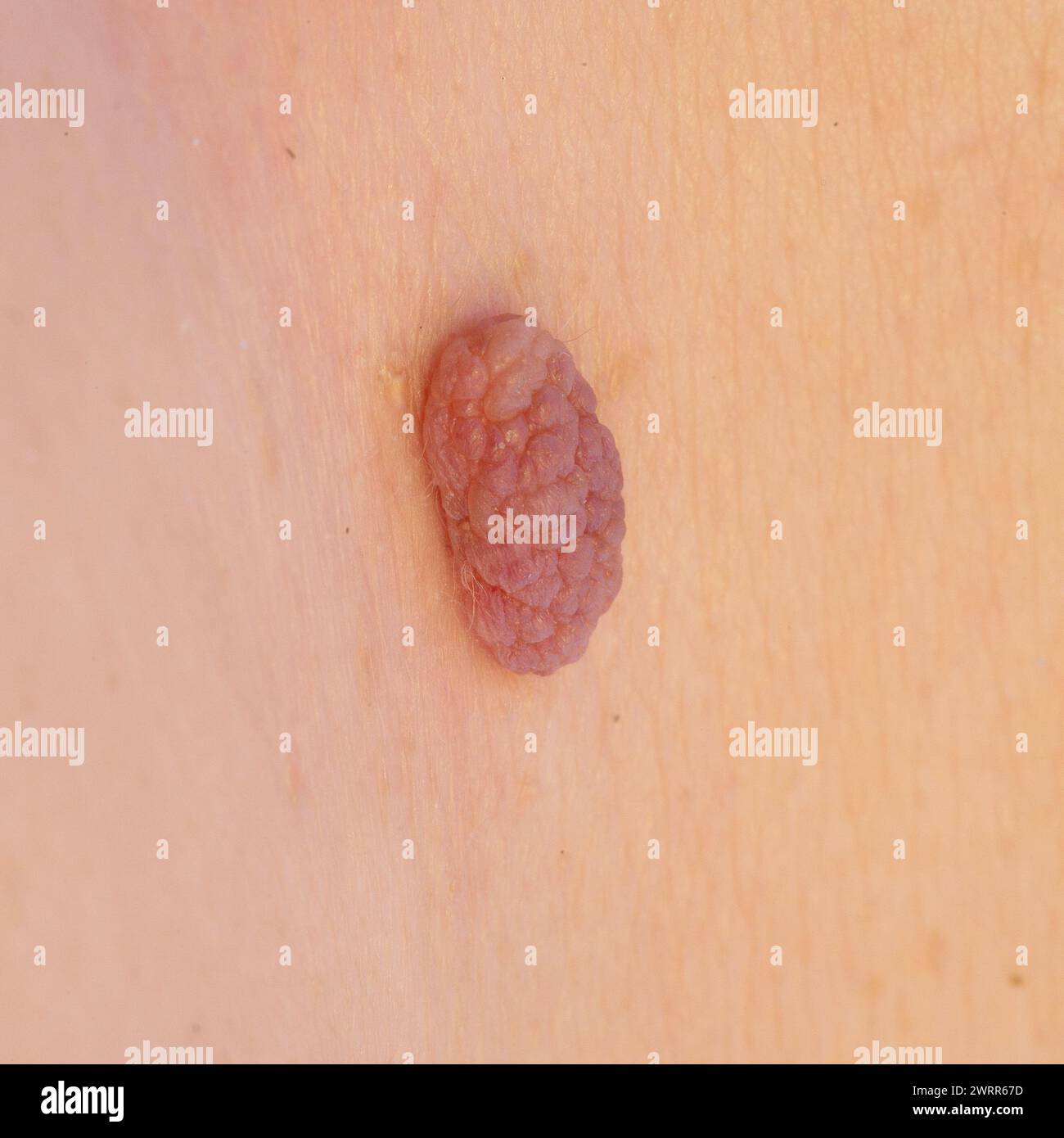 Vista ravvicinata dettagliata di un tumore benigno della pelle su pelle limpida Foto Stock