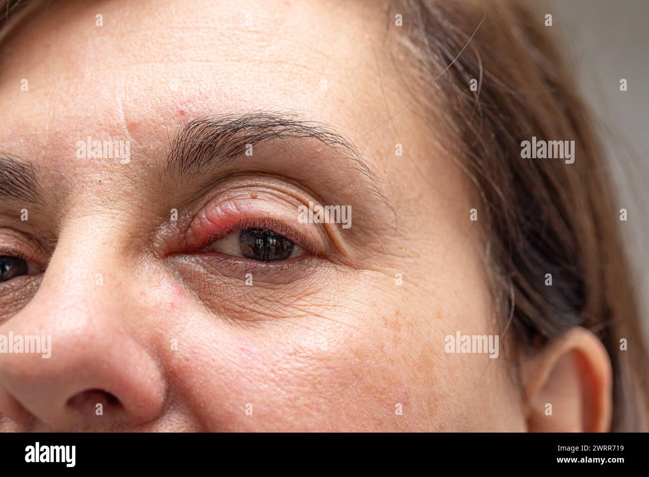 Immagine dettagliata del volto di una donna con un occhio infetto rosso Foto Stock