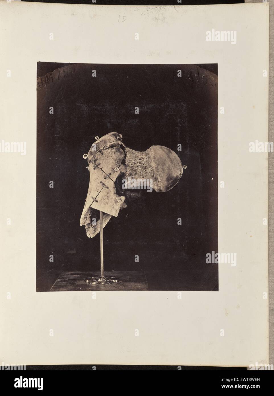 Testa, collo e trocanteri del femore destro, frantumati da una palla di moschetto conoidale, ed escizzati con successo. Forse William H. Bell, fotografo (americano, 1830 - 1910) circa 1864–1865 Ritratto di una porzione di osso femorale sospesa su un'asta attaccata ad una base di legno. Il campione è tenuto insieme da viti, fili e perni metallici. (Recto, Mount) centro superiore, scritto a mano a matita: '13' centro inferiore, scritto a mano a matita sbiadita: '53' (verso, Mount) centro, stampato su carta affissa sul supporto: 'Ufficio del chirurgo generale. / MUSEO MEDICO DELL'ESERCITO. / CAMPIONE N. 3375. Testa, collo e trocantere Foto Stock