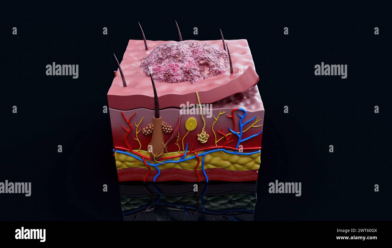 Lesione cutanea, illustrazione. Foto Stock