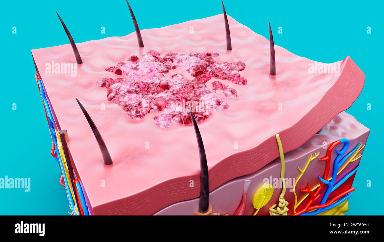 Lesione cutanea, illustrazione. Foto Stock
