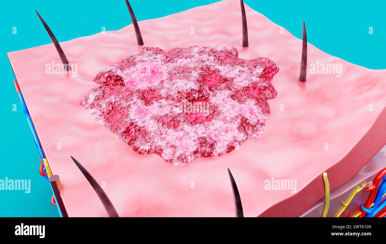 Lesione cutanea, illustrazione. Foto Stock