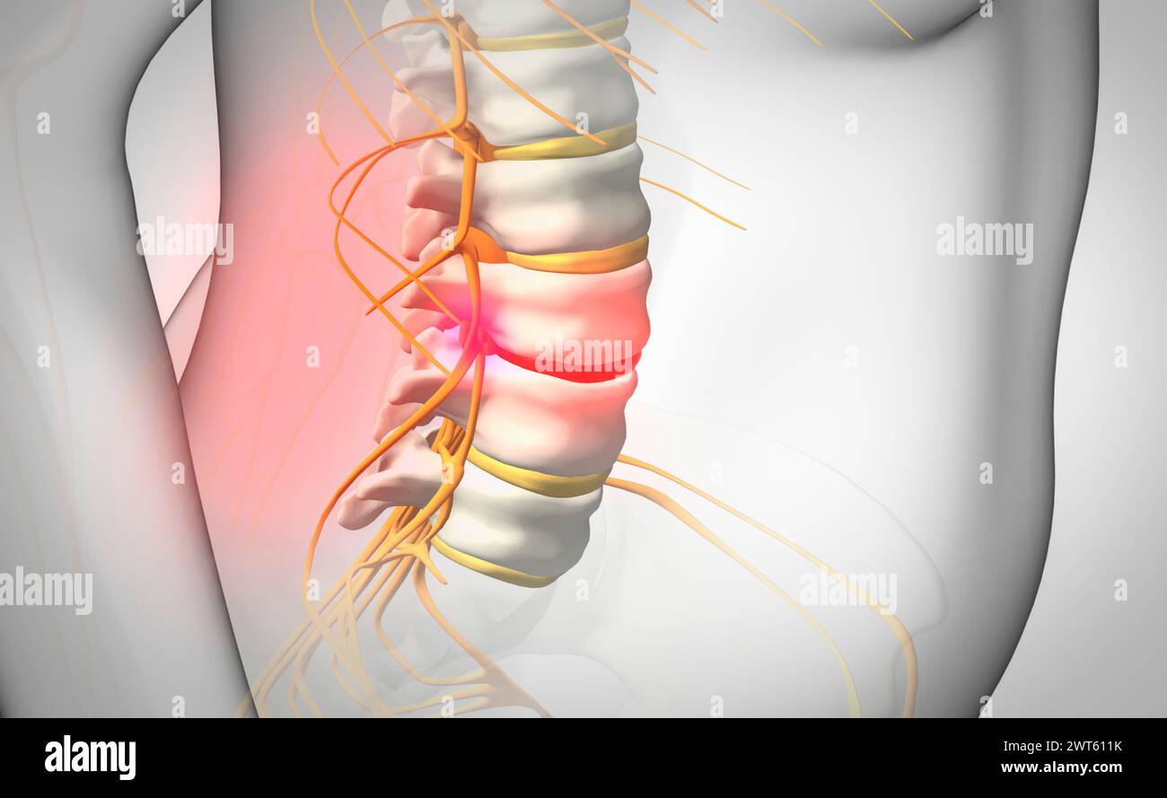 Ernia del disco spinale, illustrazione. Foto Stock