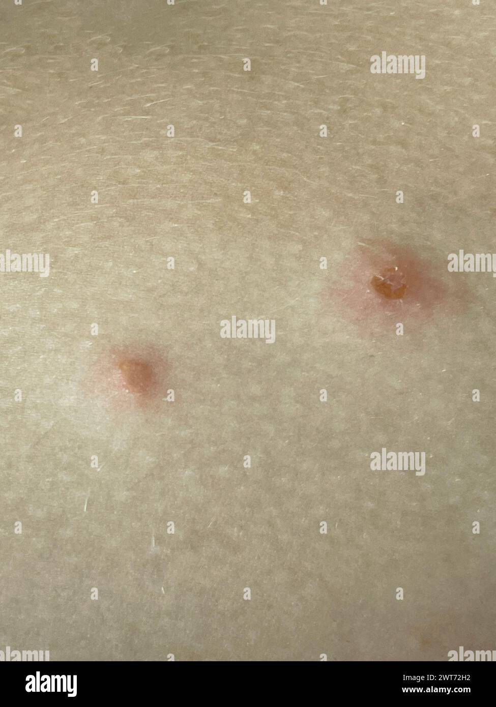 Corpo con primo piano di problemi di pelle. Malattia infettiva. Allergia, dermatite, virus o infezione batterica. Dermatologia, medicina e assistenza sanitaria. Foto Stock