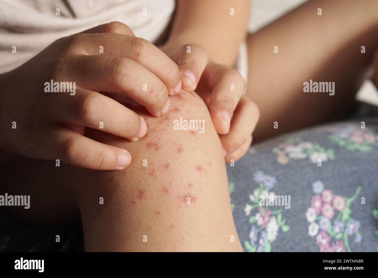 Vista ravvicinata del bambino che gratta il suo prurito al ginocchio a causa di essere infettato da mani piedi e afta epizootica o HFMD proveniente da enterovirus o coxs Foto Stock