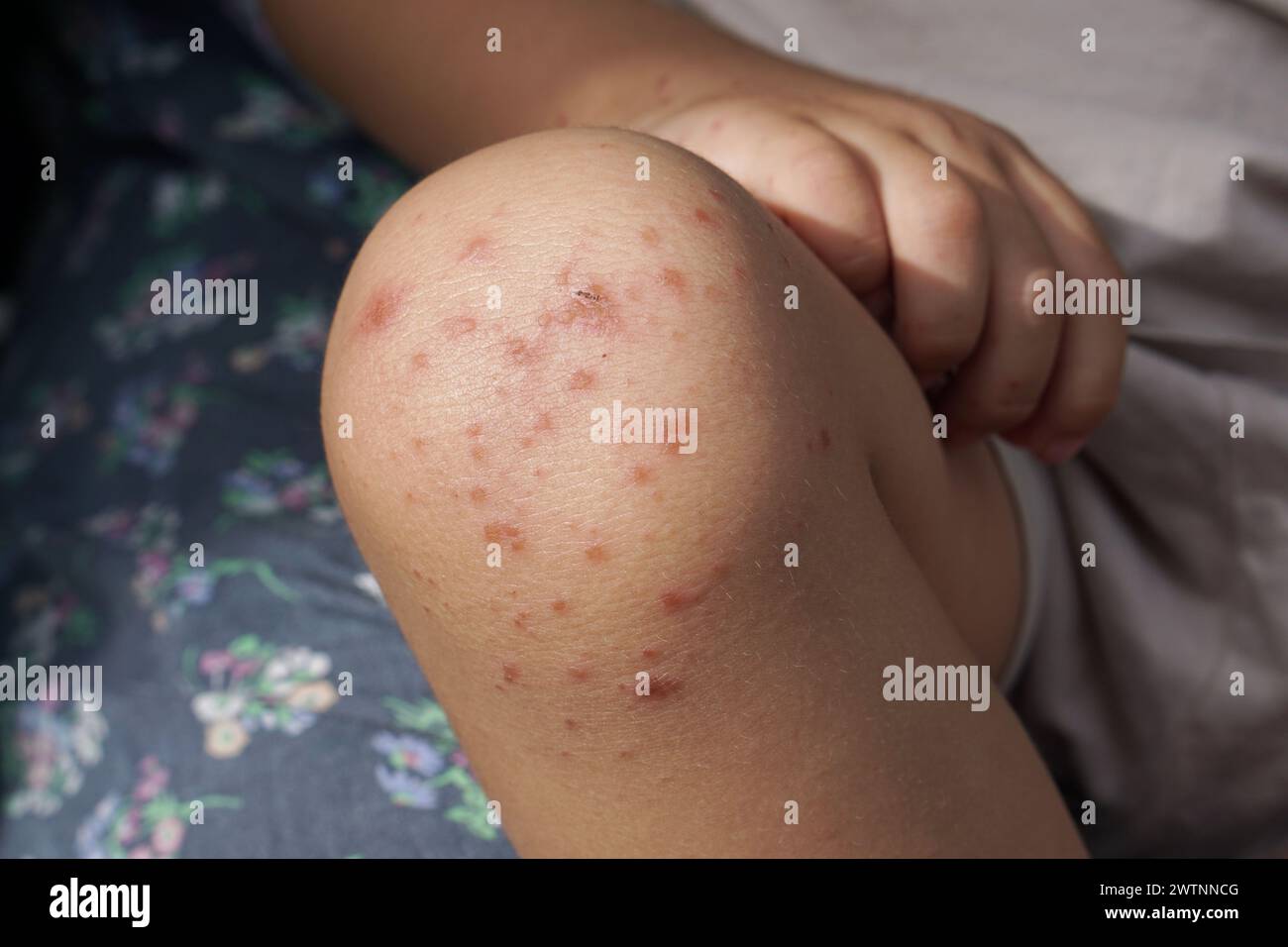 Ginocchio di un bambino infetto da afta epizootica o HFMD proveniente da enterovirus o virus della coxsackie, vista ravvicinata zoom shot. Foto Stock