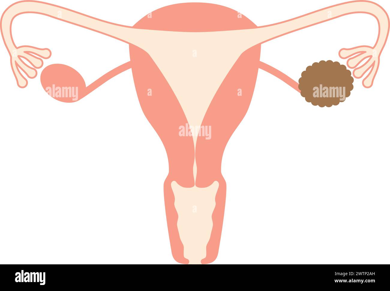 Illustrazione diagrammatica di cisti ovariche, anatomia dell'utero e delle ovaie, illustrazione vettoriale Illustrazione Vettoriale