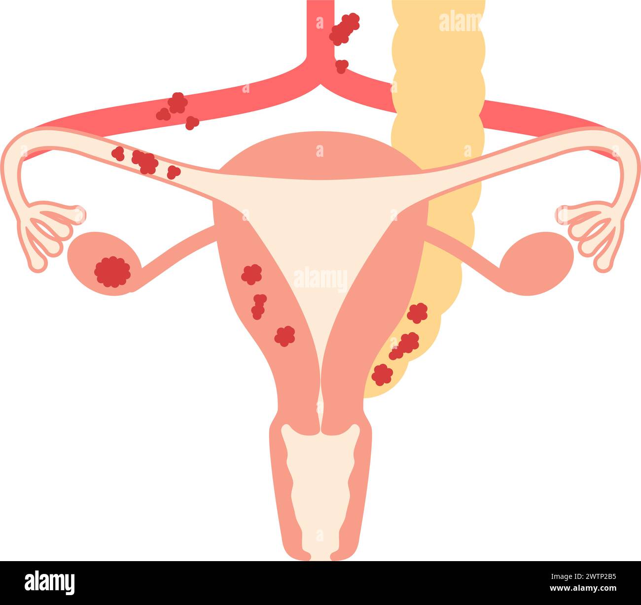 Illustrazione diagrammatica del cancro ovarico stadio III, anatomia dell'utero e delle ovaie, anatomia dell'utero e delle ovaie - traduzione: Il cancro ha Illustrazione Vettoriale