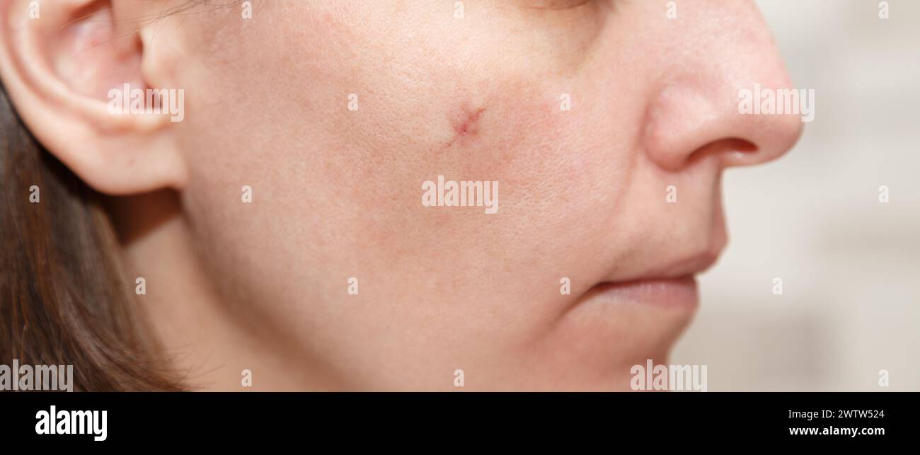 Vera cicatrice sul viso della giovane donna, cicatrice sulla guancia dopo un intervento di rimozione della talpa. Cicatrice dopo un intervento di chirurgia plastica Foto Stock