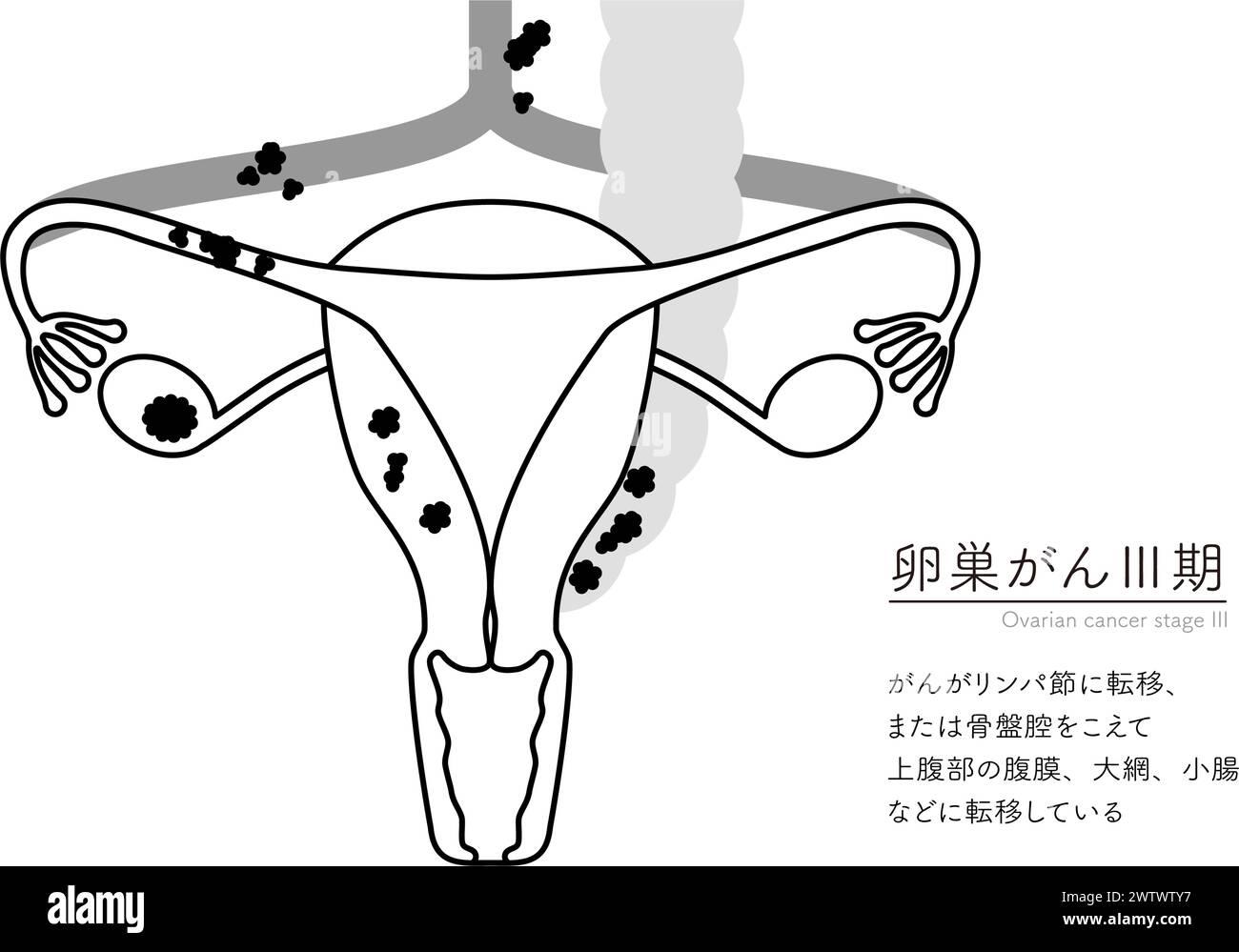 Illustrazione diagrammatica del cancro ovarico stadio III, anatomia dell'utero e delle ovaie, anatomia dell'utero e delle ovaie - traduzione: Il cancro ha Illustrazione Vettoriale