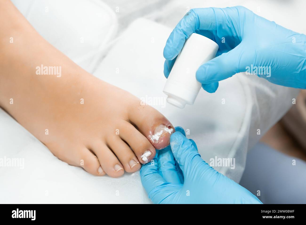 Lo specialista del piede somministra un disinfettante polveroso all'alluce dopo l'estrazione dell'unghia. Foto Stock