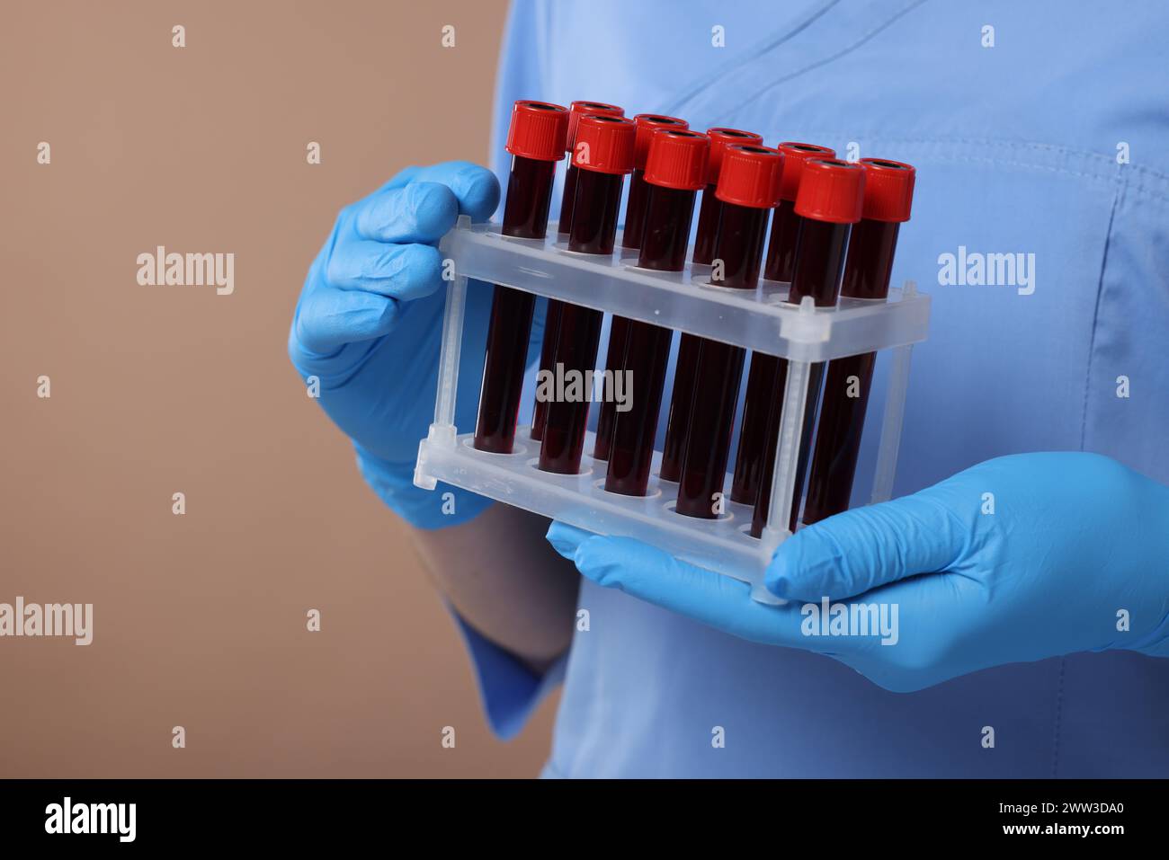 Analisi di laboratorio. Medico con campioni di sangue in provette su sfondo marrone chiaro, primo piano Foto Stock