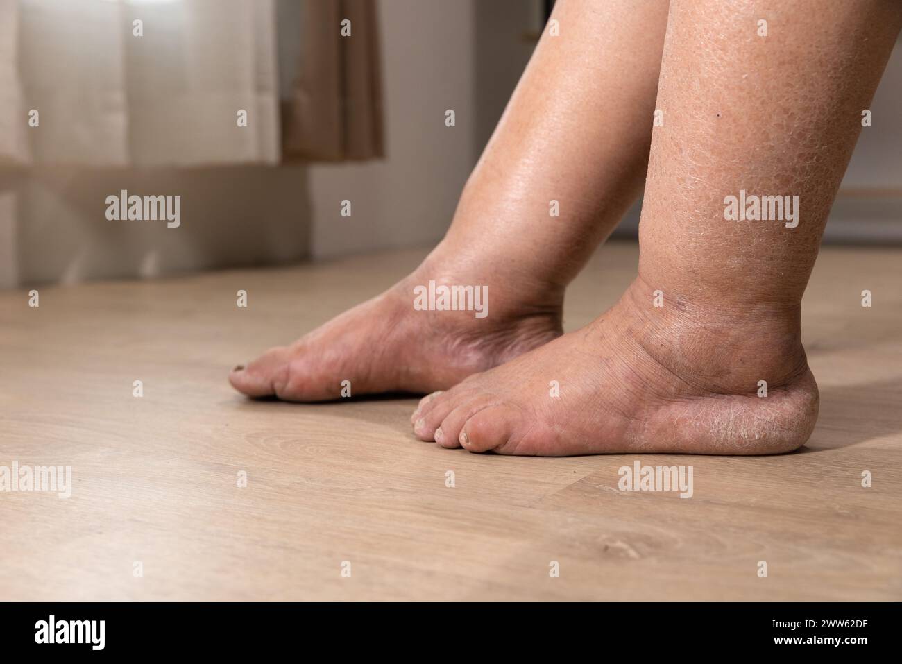 La gamba della donna è edema (gonfiore) dopo il trattamento del cancro. Foto Stock