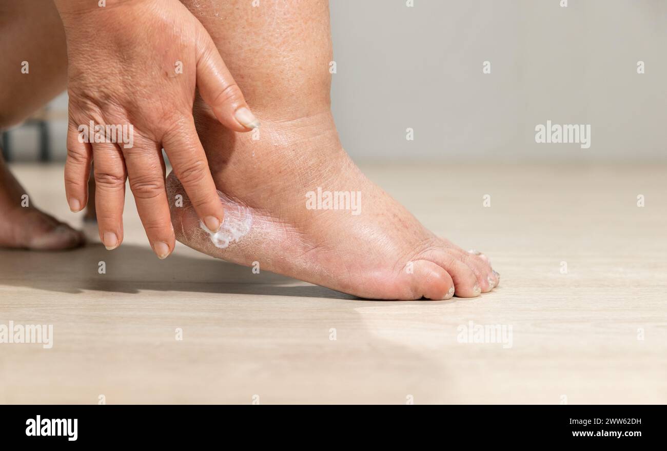 Donna applicare lozione di umidità sull'edema (gonfiore) gamba dopo il trattamento del cancro. Tallone rotto. Foto Stock